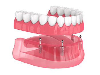 Implant Supported Dentures | Dentures Titusville FL