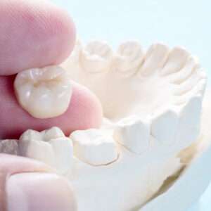 Dental Crowns Port St. John FL | Best Titusville Dentists