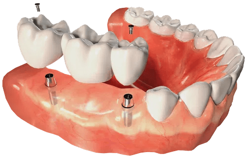 Dental Implants Port St. John FL