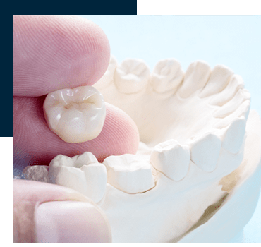 Dental Crowns Port St. John FL| Best Titusville Dentists