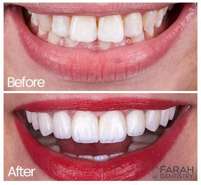 Teeth Whitening Mims FL